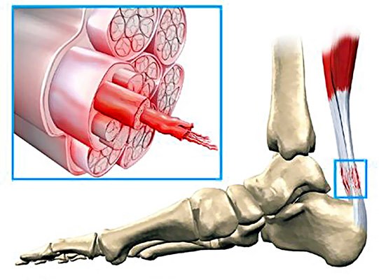 Peri-tendinitis of a tendon diagram.