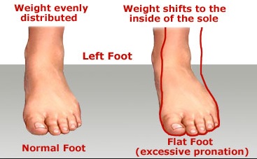 Left Foot Seen  Foot pronation