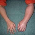 Image of hand with Raynauds Disease.