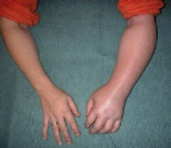 Image of hand with Raynauds Disease.