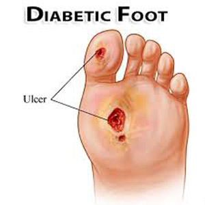 Diabetic Foot Diabetic Foot