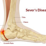 Image of foot with sever disease | Featured image for Traction Apophysitis blog.