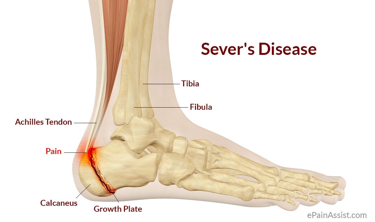 Image of foot with sever disease | Featured image for Traction Apophysitis blog.