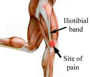 ITB friction syndrome | Pivotal Motion Physiotherapy