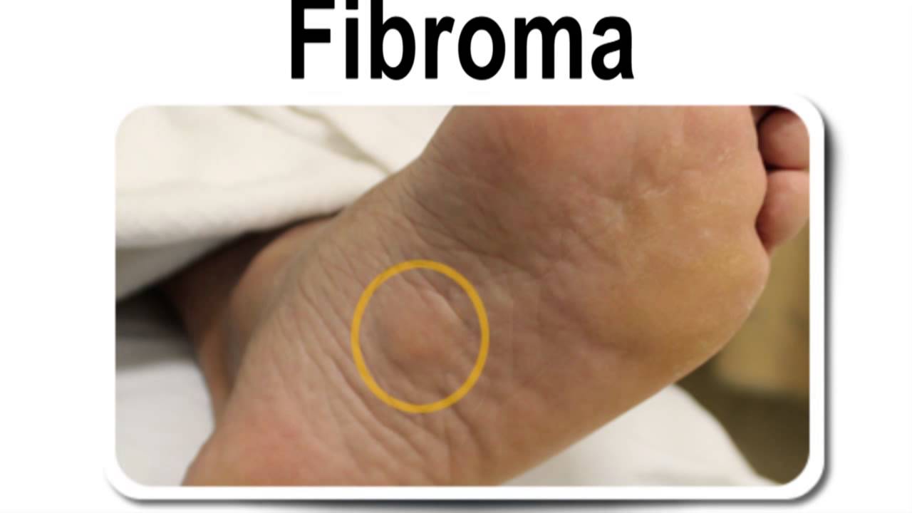 Plantar Fibroma Foot Tumor
