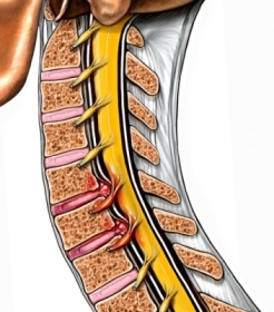 Acute Wry Neck