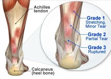 Grading scale of Achilles tendon tear