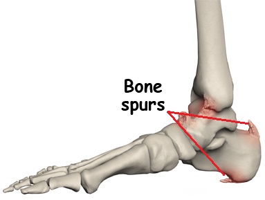 bone-spur injury