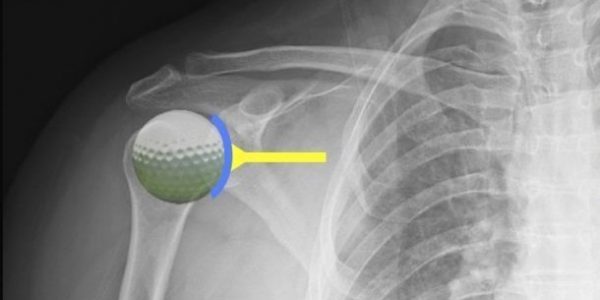 Rotator cuff tear | Featured Image for the Shoulder Impingement Treatment Page of Pivotal Motion Physiotherapy.