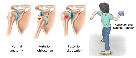 Shoulder Dislocation Exercise