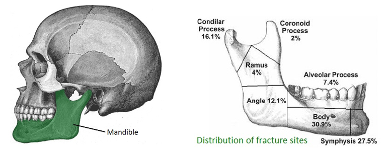 Skeletal display of distribution of jaw fractures | Featured image for What Is A Jaw Fracture service page at Pivotal Motion.