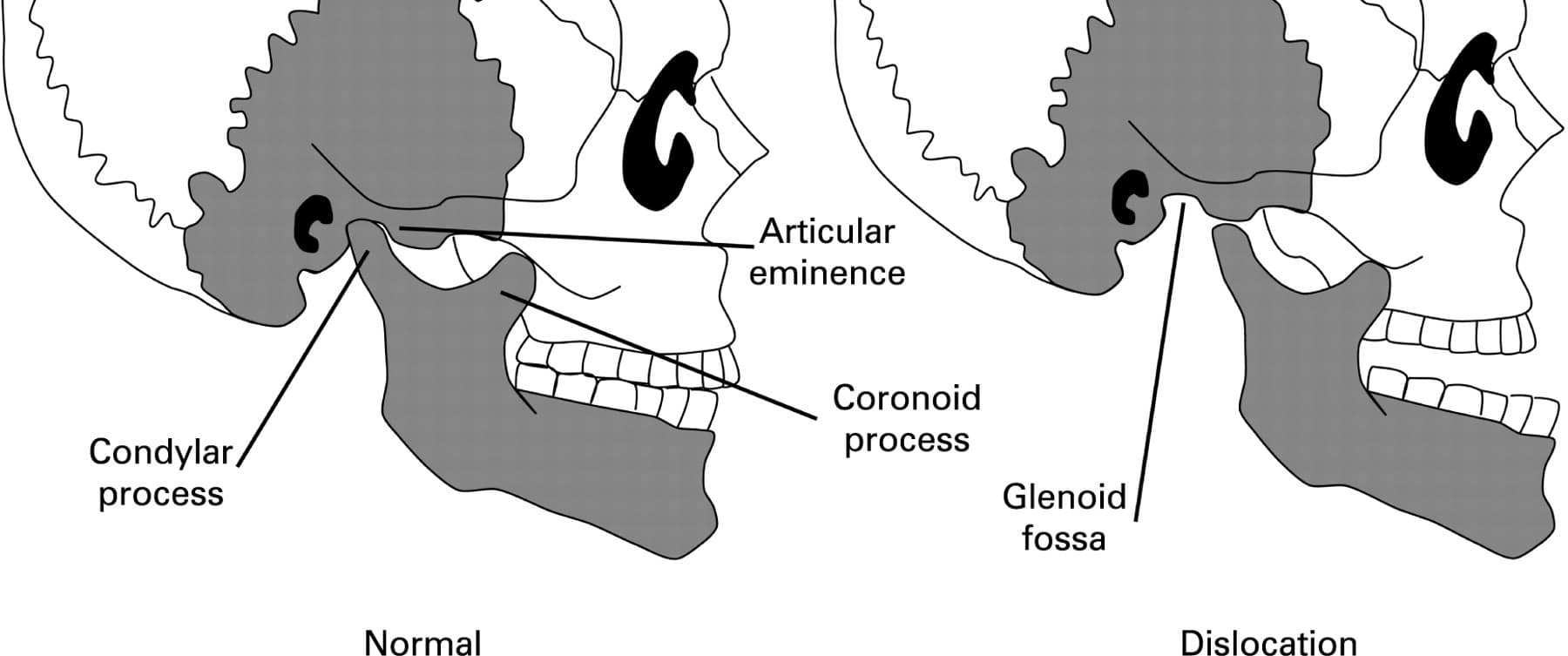 Diagram of skull indicating jaw dislocation.