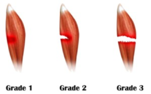 Grading scale of muscle tears
