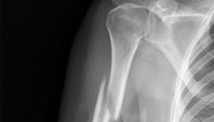 X-ray showing a humeral fracture | featured image for Home.