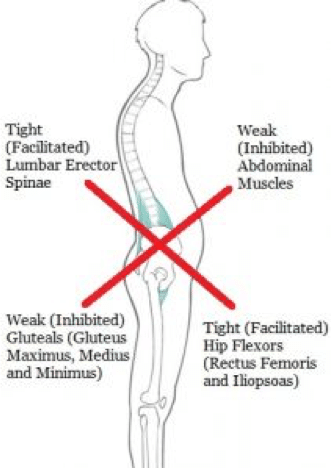 Lower Cross Syndrome