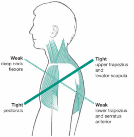 Upper Cross Syndrome