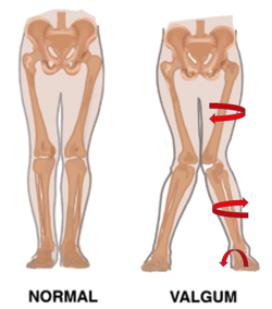 Valgus Posture