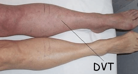 Physiotherapy for Deep Vein Thrombosis (DVT)