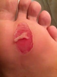 How to deal with blisters.