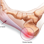 plantar fasciitis diagram | Featured image for The Real Cause of Plantar Fasciitis blog for Pivotal Motion Physiotherapy.