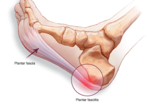 plantar fasciitis diagram