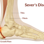 Sever's disease diagram