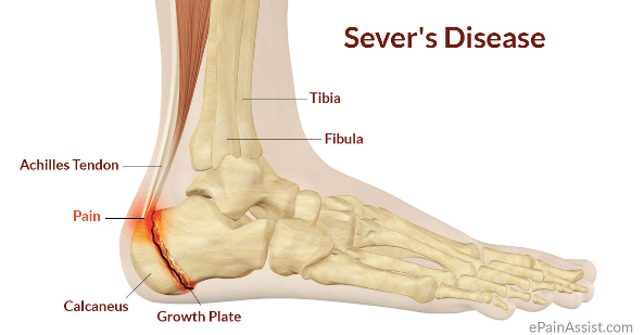 Sever's disease diagram