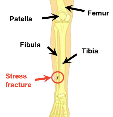 Stress fractures diagram