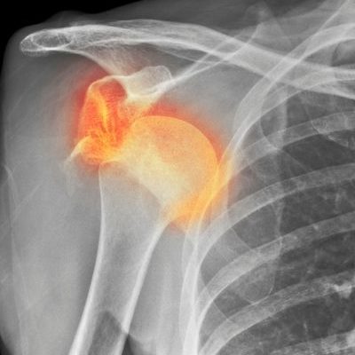 X-ray indicating inflammation in the shoulder | featured image for Arm Physiotherapy.