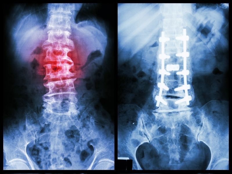 An X-Ray of a persons torso | Featured image for Spondylolisthesis.