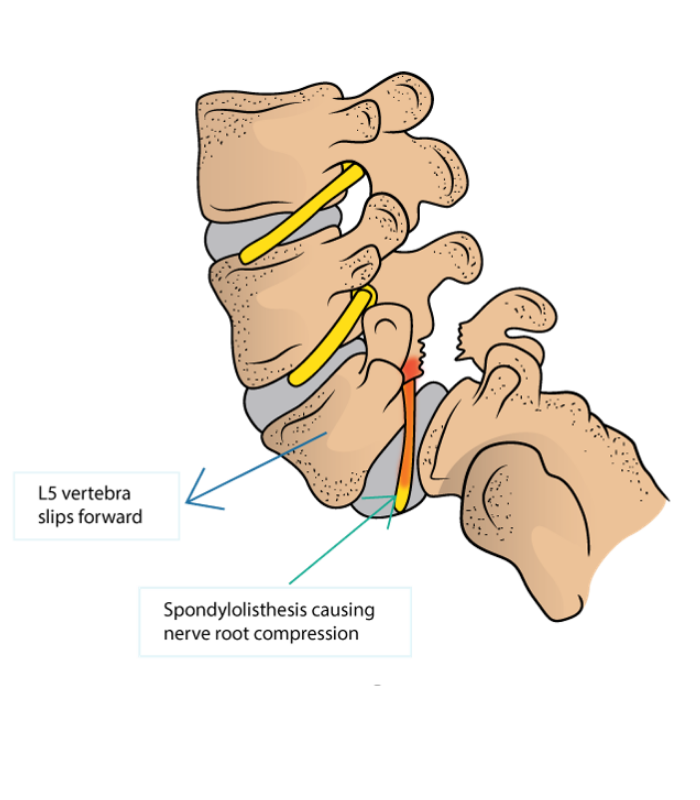 An illustration of spondylolisthesis | Featured image for Spondylolisthesis.