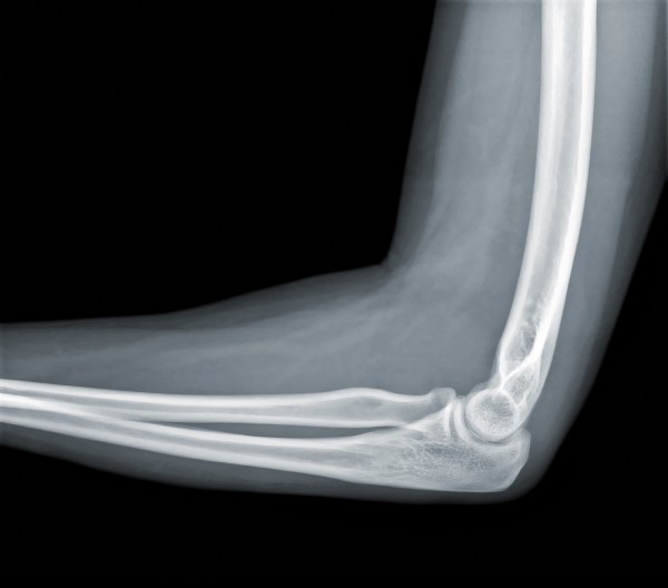 Xray of elbow